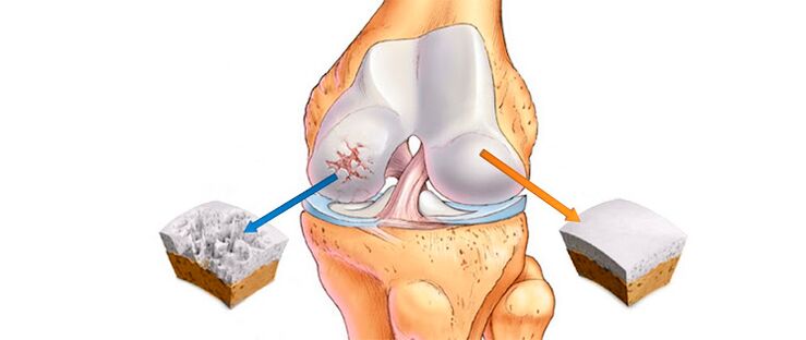 A térdízület deformáló arthrosisa (balra) és egészséges ízület (jobbra)